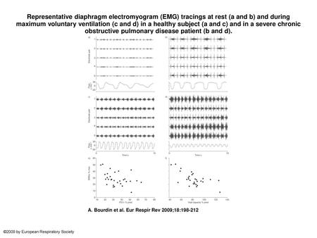 Representative diaphragm electromyogram (EMG) tracings at rest (a and b) and during maximum voluntary ventilation (c and d) in a healthy subject (a and.