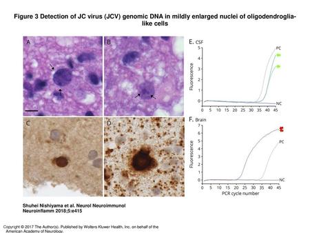 Figure 3 Detection of JC virus (JCV) genomic DNA in mildly enlarged nuclei of oligodendroglia-like cells Detection of JC virus (JCV) genomic DNA in mildly.