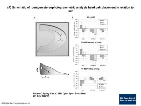 (A) Schematic of roentgen stereophotogrammetric analysis bead pair placement in relation to tear. (A) Schematic of roentgen stereophotogrammetric analysis.