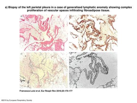 A) Biopsy of the left parietal pleura in a case of generalised lymphatic anomaly showing complex proliferation of vascular spaces infiltrating fibroadipose.