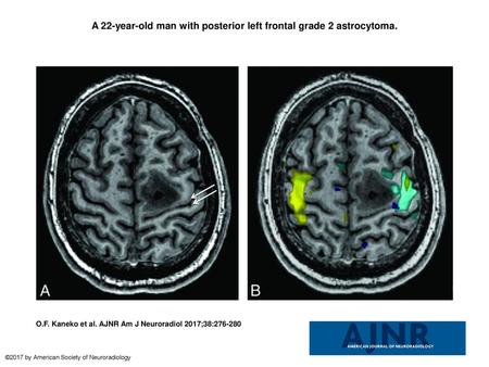 A 22-year-old man with posterior left frontal grade 2 astrocytoma.