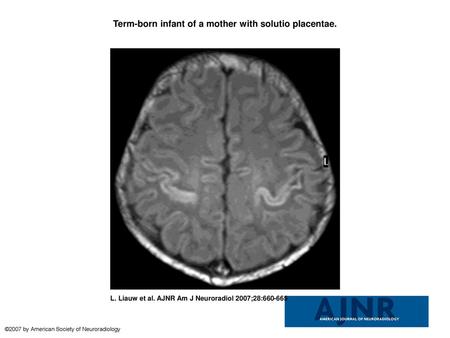 Term-born infant of a mother with solutio placentae.