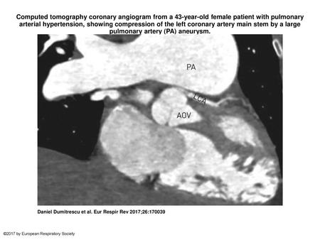 Computed tomography coronary angiogram from a 43-year-old female patient with pulmonary arterial hypertension, showing compression of the left coronary.