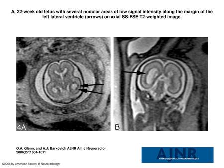 A, 22-week old fetus with several nodular areas of low signal intensity along the margin of the left lateral ventricle (arrows) on axial SS-FSE T2-weighted.