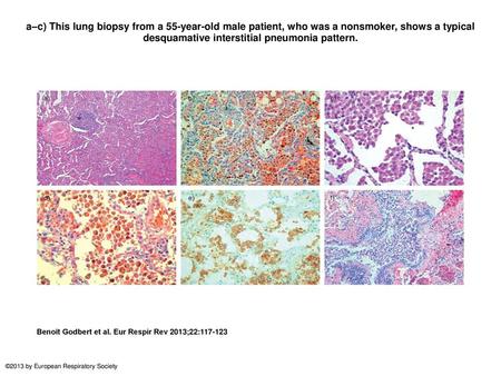 A–c) This lung biopsy from a 55-year-old male patient, who was a nonsmoker, shows a typical desquamative interstitial pneumonia pattern. a–c) This lung.