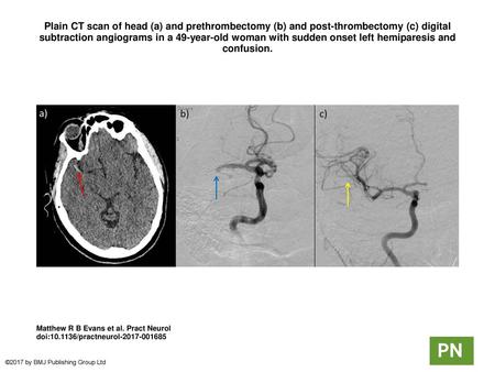 Plain CT scan of head (a) and prethrombectomy (b) and post-thrombectomy (c) digital subtraction angiograms in a 49-year-old woman with sudden onset left.