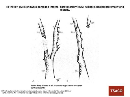 To the left (A) is shown a damaged internal carotid artery (ICA), which is ligated proximally and distally. To the left (A) is shown a damaged internal.