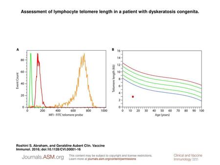 Assessment of lymphocyte telomere length in a patient with dyskeratosis congenita. Assessment of lymphocyte telomere length in a patient with dyskeratosis.