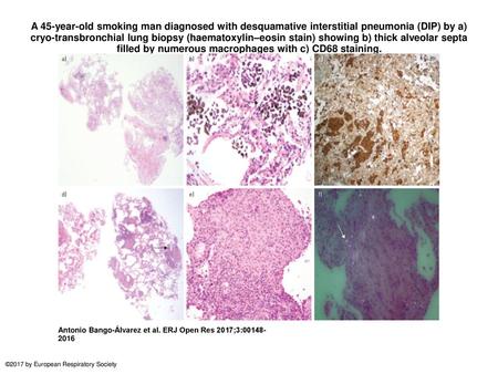 A 45-year-old smoking man diagnosed with desquamative interstitial pneumonia (DIP) by a) cryo-transbronchial lung biopsy (haematoxylin–eosin stain) showing.