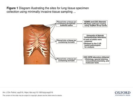 Figure 1 Diagram illustrating the sites for lung tissue specimen collection using minimally invasive tissue sampling ... Figure 1 Diagram illustrating.