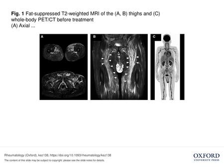 (A) Axial ... (A) Axial images showed symmetric, strong high intensity in the connective tissues surrounded by femoral muscles and mild high intensity.