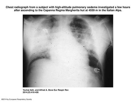 Chest radiograph from a subject with high-altitude pulmonary oedema investigated a few hours after ascending to the Capanna Regina Margherita hut at 4559.