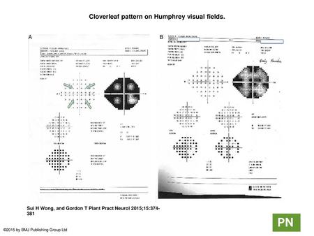 Cloverleaf pattern on Humphrey visual fields.