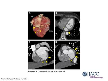 Hampton A. Crimm et al. JACEP 2016;2: