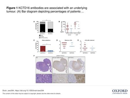 Figure 1 KCTD16 antibodies are associated with an underlying tumour