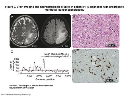 Figure 3. Brain imaging and neuropathologic studies in patient PT-5 diagnosed with progressive multifocal leukoencephalopathy Brain imaging and neuropathologic.