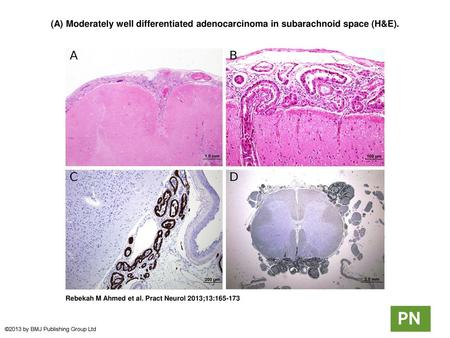 (A) Moderately well differentiated adenocarcinoma in subarachnoid space (H&E). (A) Moderately well differentiated adenocarcinoma in subarachnoid space.