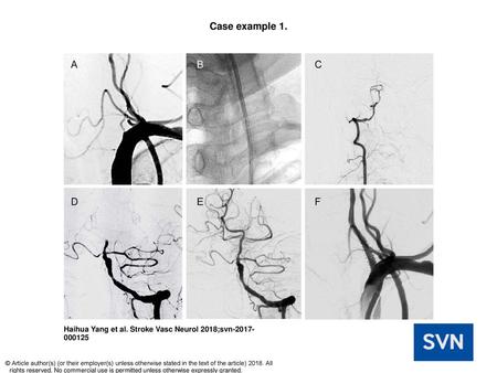 Case example 1. Case example 1. (A) Left vertebral artery occlusion. (B) A 6 Fr catheter crossing the left vertebral artery through the stent over the.