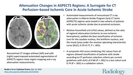 Attenuation Changes in ASPECTS Regions: A Surrogate for CT Perfusion–based Ischemic Core in Acute Ischemic Stroke Automated measurements of noncontrast.