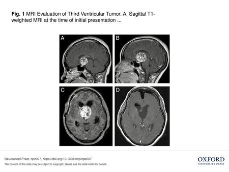 Fig. 1 MRI Evaluation of Third Ventricular Tumor