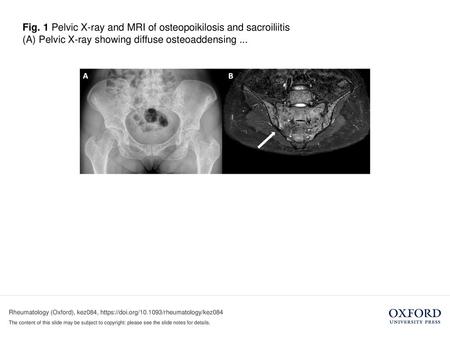 (A) Pelvic X-ray showing diffuse osteoaddensing ...