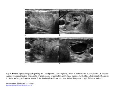 Fig. 4. Korean Thyroid Imaging Reporting and Data System 3 (low suspicion). None of nodules have any suspicious US features such as microcalcification,