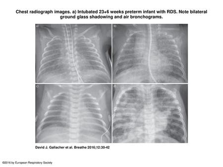 Chest radiograph images