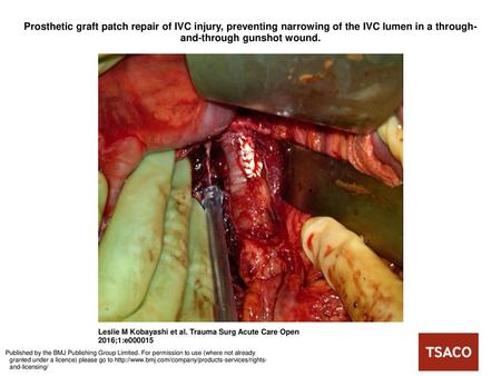 Prosthetic graft patch repair of IVC injury, preventing narrowing of the IVC lumen in a through-and-through gunshot wound. Prosthetic graft patch repair.