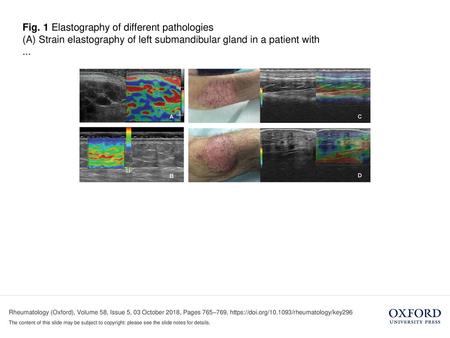 (A) Strain elastography of left submandibular gland in a patient with ... (A) Strain elastography of left submandibular gland in a patient with SS. An.