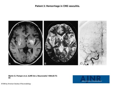 Patient 3: Hemorrhage in CNS vasculitis.