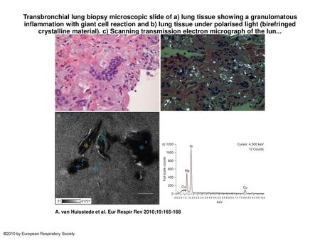 Transbronchial lung biopsy microscopic slide of a) lung tissue showing a granulomatous inflammation with giant cell reaction and b) lung tissue under polarised.