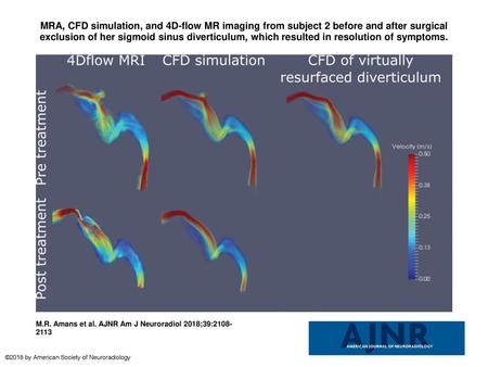 MRA, CFD simulation, and 4D-flow MR imaging from subject 2 before and after surgical exclusion of her sigmoid sinus diverticulum, which resulted in resolution.