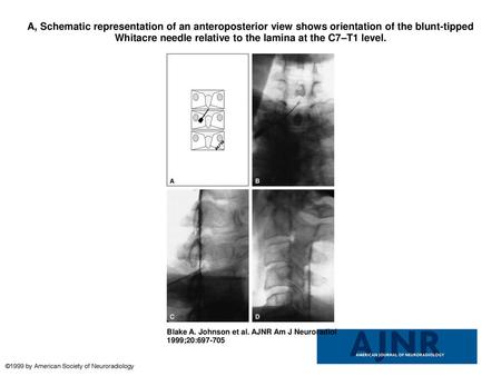 A, Schematic representation of an anteroposterior view shows orientation of the blunt-tipped Whitacre needle relative to the lamina at the C7–T1 level.