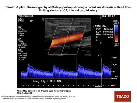 Carotid duplex ultrasonography at 60 days post-op showing a patent anastomosis without flow-limiting stenosis. ICA, internal carotid artery. Carotid duplex.