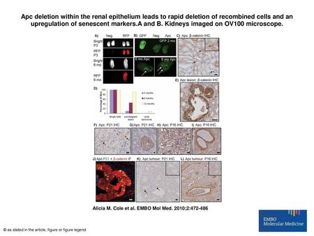 Apc deletion within the renal epithelium leads to rapid deletion of recombined cells and an upregulation of senescent markers.A and B. Kidneys imaged on.