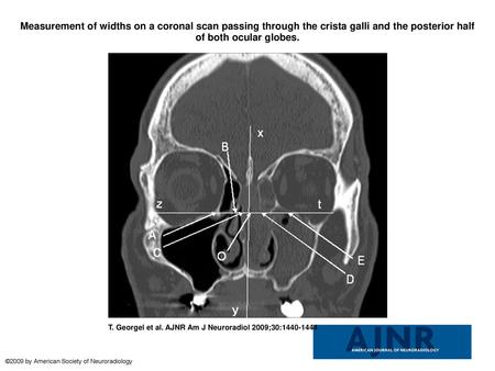 Measurement of widths on a coronal scan passing through the crista galli and the posterior half of both ocular globes. Measurement of widths on a coronal.