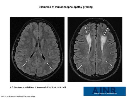 Examples of leukoencephalopathy grading.