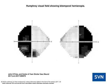 Humphrey visual field showing bitemporal hemianopia.