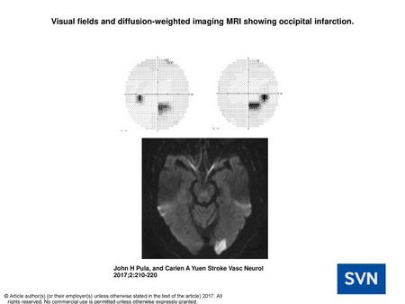 Visual fields and diffusion-weighted imaging MRI showing occipital infarction. Visual fields and diffusion-weighted imaging MRI showing occipital infarction.