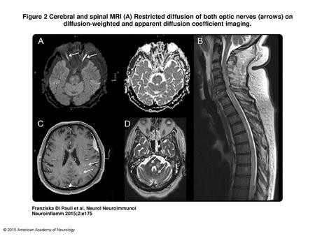 Figure 2 Cerebral and spinal MRI (A) Restricted diffusion of both optic nerves (arrows) on diffusion-weighted and apparent diffusion coefficient imaging.