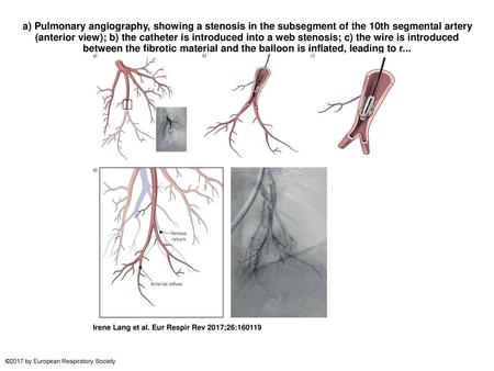 A) Pulmonary angiography, showing a stenosis in the subsegment of the 10th segmental artery (anterior view); b) the catheter is introduced into a web stenosis;