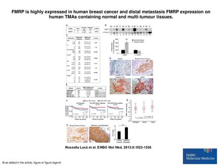 FMRP is highly expressed in human breast cancer and distal metastasis FMRP expression on human TMAs containing normal and multi‐tumour tissues. FMRP is.