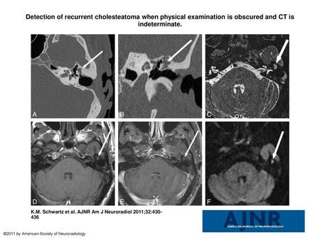 Detection of recurrent cholesteatoma when physical examination is obscured and CT is indeterminate. Detection of recurrent cholesteatoma when physical.