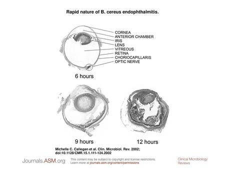 Rapid nature of B. cereus endophthalmitis.