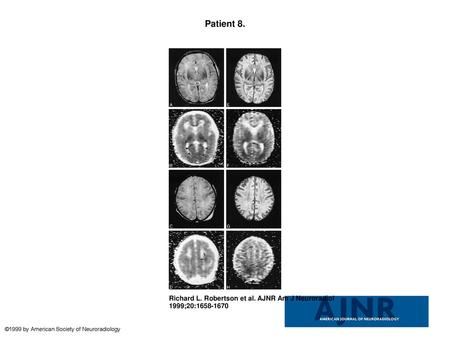 Patient 8. Patient 8. Neonate of estimated 39-week gestational age with a lacerated, prolapsed umbilical cord. A, Axial T2-weighted fast spin-echo image.