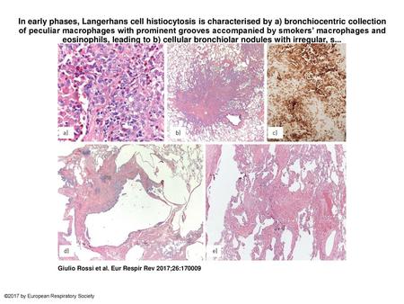 In early phases, Langerhans cell histiocytosis is characterised by a) bronchiocentric collection of peculiar macrophages with prominent grooves accompanied.