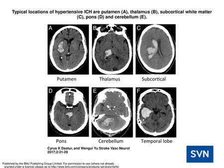 Typical locations of hypertensive ICH are putamen (A), thalamus (B), subcortical white matter (C), pons (D) and cerebellum (E). Typical locations of hypertensive.