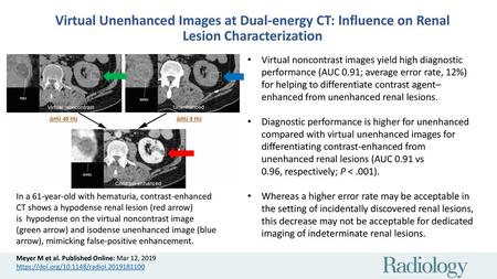 Virtual noncontrast images yield high diagnostic performance (AUC 0