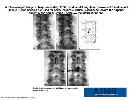 A, Fluoroscopic image with approximately 15° left and caudal angulation shows a 3.5-inch spinal needle (5-inch needles are used for obese patients), which.