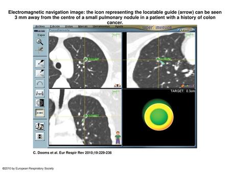 Electromagnetic navigation image: the icon representing the locatable guide (arrow) can be seen 3 mm away from the centre of a small pulmonary nodule in.